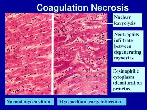 Ppt First Foundations Essentials Of General Human Pathology