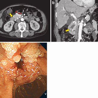 Contrast Enhanced Abdominal Ct Showed A Mass Of Mm In Diameter In