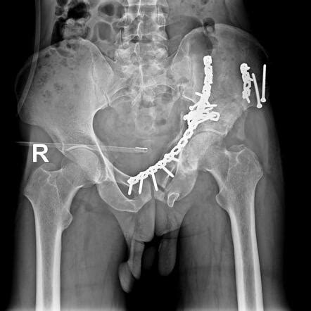 Urethral Stricture Radiology Case Radiopaedia Org