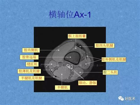 膝关节mri高清解剖图解，值得收藏！ 好医术文章 好医术 赋能医生守护生命