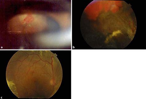 Figure 1 From A Large Retinal Capillary Hemangioma In The Anterior Retina Treated With