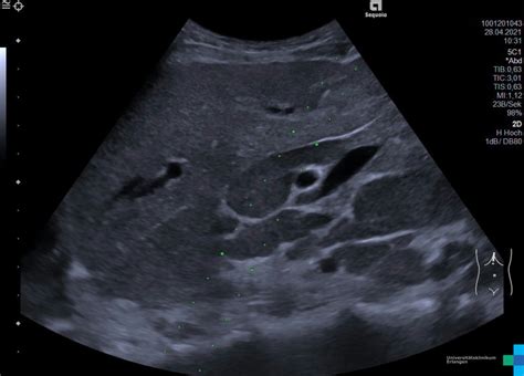 Transhepatic Lymph Node Biopsy Atlas Of Ultrasound