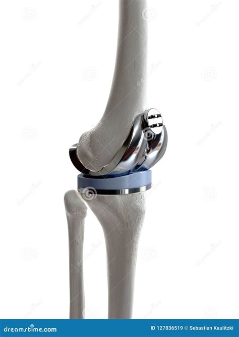 A knee replacement stock illustration. Illustration of patella - 127836519