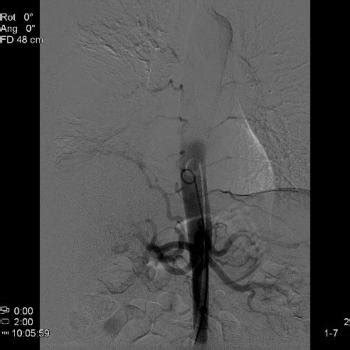 Abdominal Aortography. | Download Scientific Diagram