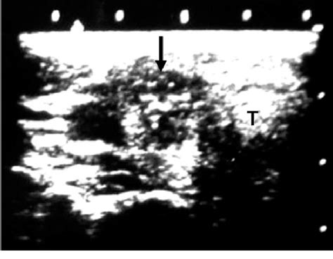 Transverse Section Of The Right Lobe Of The Thyroid By Ultrasonography