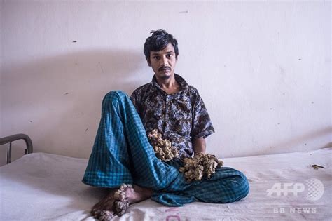 バングラデシュの「樹木男」、両手切断を希望 耐え難い痛み訴え 写真5枚 国際ニュース：afpbb News