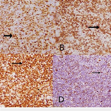 IHC Profile Shows A Nuclear Staining Of C Myc In 40 Of Tumor Cells