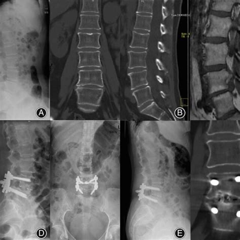 A 56 Year Old Female Patient Underwent Transforaminal Lumbar Interbody Download Scientific