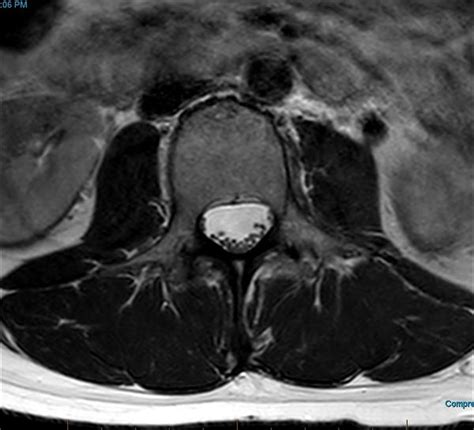 Lumbar Spine Mri Wikimsk