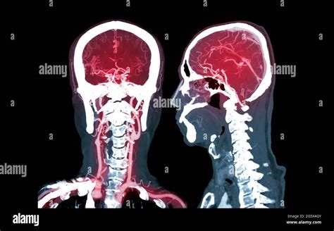 Gehirn Anatomie Sagittale Ansicht Fotos Und Bildmaterial In Hoher