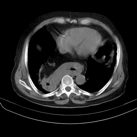 hiatal hernia pediatric radiology - Rasheeda Knox