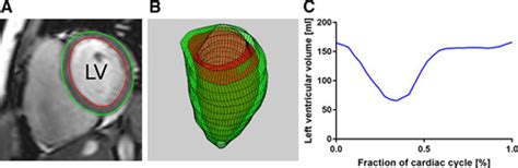 Noninvasive Quantification Of Pressure Volume Loops From Brachial