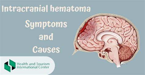 Intracranial hematoma - HTI CENTERS | Medical Tourism Center