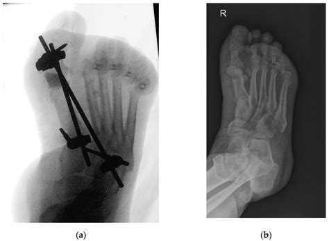 Applied Sciences Free Full Text Preservation Surgery Of Septic