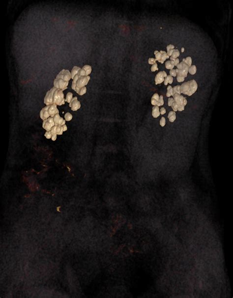 Medullary Nephrocalcinosis Due To Type 1 Renal Tubular Acidosis Image