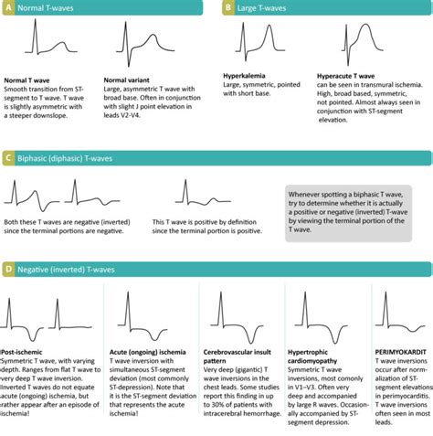 The T-wave: physiology, variants and ECG features