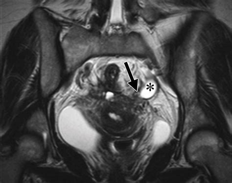 Findings Of Pelvic Endometriosis At Transvaginal Us Mr Imaging And