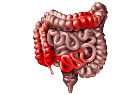 Definitie Van Biologische Remissie Bij De Ziekte Van Crohn Nut