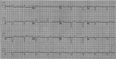 The Lead Resting Electrocardiogram Ecg Showing Normal Sinus Rhythm