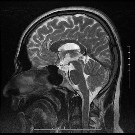 Schizencephaly Bilateral Open Lip Image Radiopaedia Org