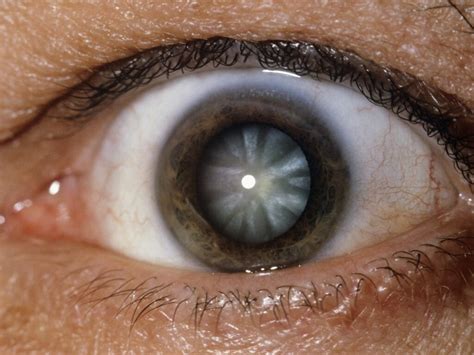 Cortical Cataract: Everything You Need To Know About It