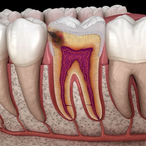 Hidden Caries In To Molar Tooth Medically Accurate 3D Illustration