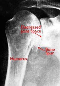 Shoulder Arthritis | Shoulder Joint Replacement | Arthroplasty | Dr ...