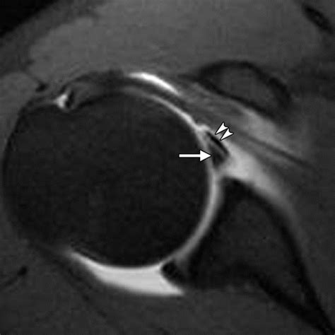 Imaging The Glenoid Labrum And Labral Tears Radiographics