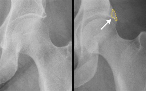 Hip Impingement Exercises - [P]rehab