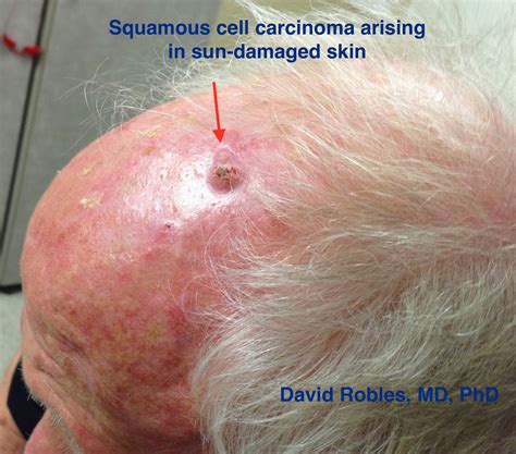 Albums 92 Pictures Photos Of Melanoma On Scalp Latest