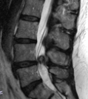 Synovial Cyst In Lumbar Spine Cysts Spine Surgery Bulging Disc