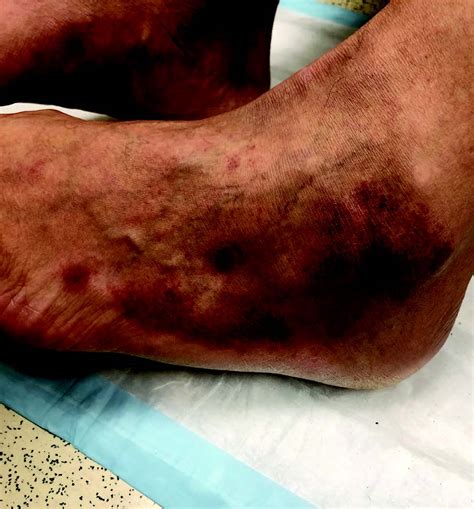 List 94 Pictures Leg Discoloration Due To Poor Circulation Pictures Superb