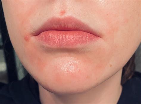 Redness Around Mouth