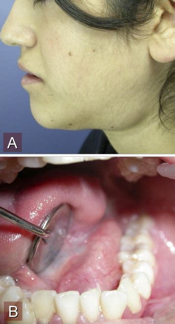 Floor Of Mouth Dermoid Cyst