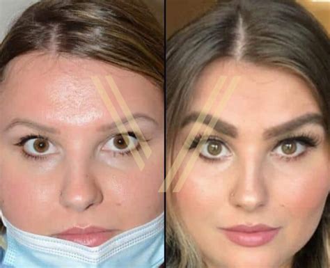 Eyebrow Transplant In Turkey 2025 Prices Vantage Clinic