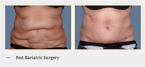 Tummy Tuck San Francisco Bay Area Tummy Tuck San Francisco Flickr