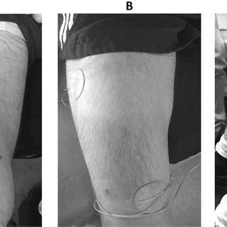 Motor Point Identification In Thigh And Calf Muscles Mapping Of Motor