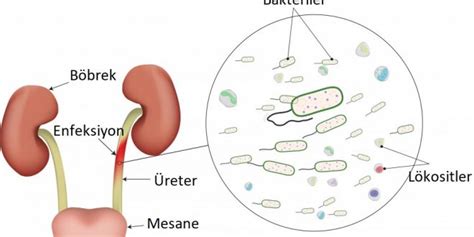 İDRAR YOLU ENFEKSİYONU NEDİR BELİRTİLERİ NELERDİR DOKTORUMNEDİO