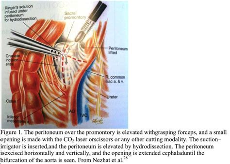 Sacral Promontory Blood Vessels