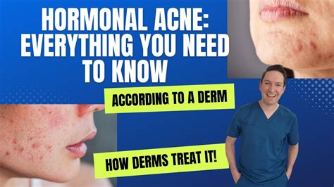 How To Tell If You Have Hormonal Acne Dermatologist Hormonalacne Spironolactone Adultacne