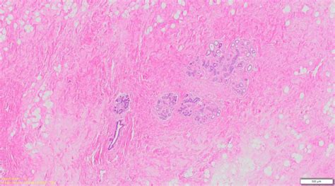 Human Breast Cancer With Er Pr Her21p53and Normal Matched