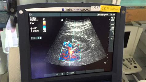 Sonosite Micromaxx Portable Ultrasound Youtube