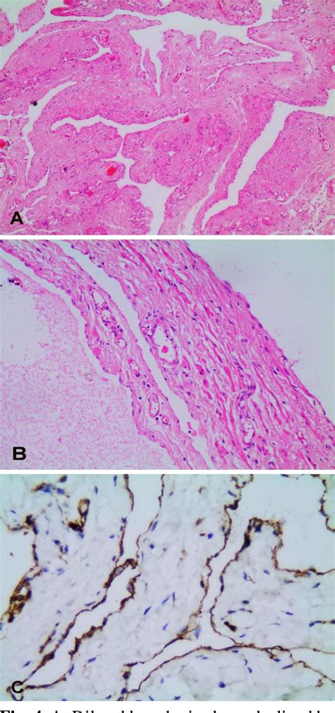 Figure 1 From Perineal And Scrotal Lymphangioma In A 3 Year Old Male