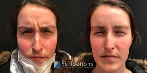 First Time Botox Results At 30 Before And After Photos New Jersey Reflections Center