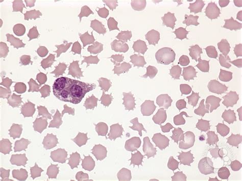 Acanthocytosis - 3.