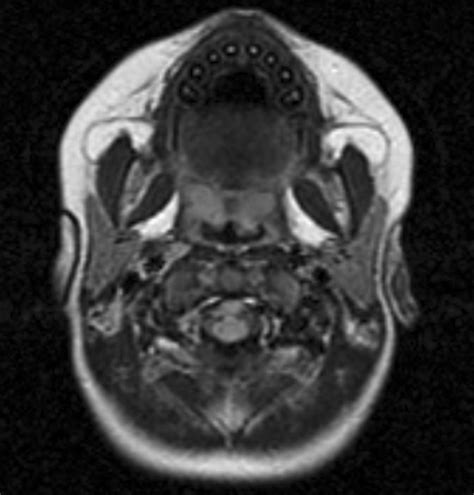 Normal Mri Appearance And Motion Related Phenomena Of Csf Ajr