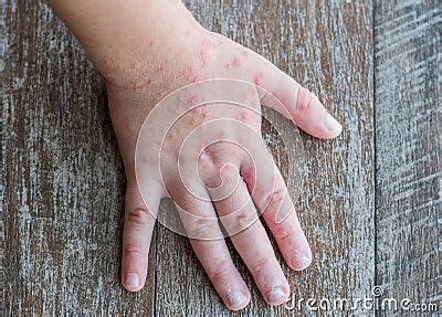 Coxsackie Virus. Child With A Skin Rash. Stock Photography ...