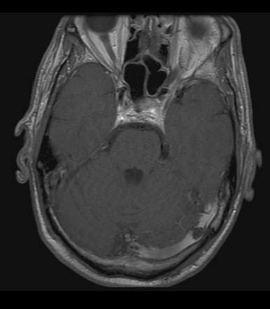 Arachnoid granulation | Radiology Case | Radiopaedia.org