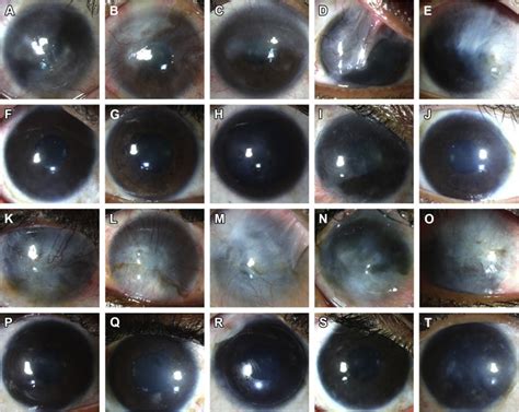 Slit Lamp Photographs Showing 2 Year Clinical Outcomes Of Simple Limbal Download Scientific