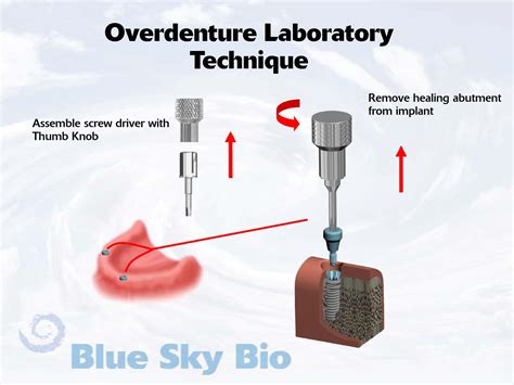 Overdenture Laboratory Technique for other systems by Blue Sky BIO - Issuu